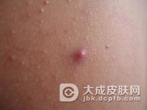 具体的吃什么对毛囊炎好呢