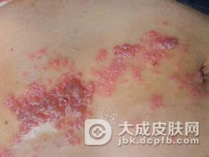 引发单纯性疱疹的病因到底都有些什么