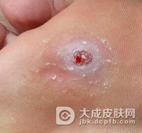 跖疣的治疗方法有哪些啊