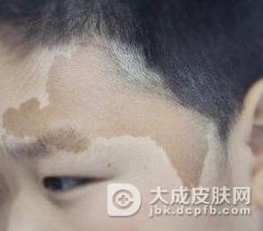 咖啡斑可靠的治疗办法是什么