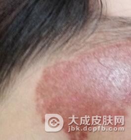 婴儿咖啡斑能不能治