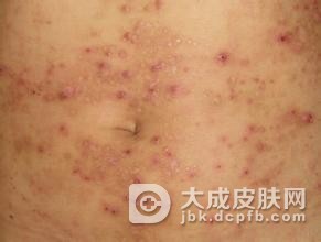 单纯痒疹的症状表现主要是什么