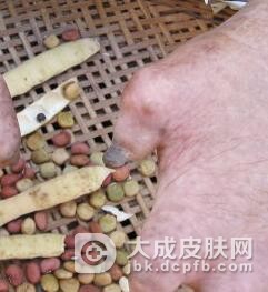 麻风病所造成的并发症有哪些