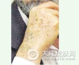 老年斑猛增或是癌症预警信号