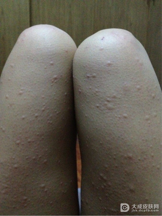 荨麻疹久治不愈怎么治