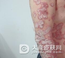 副银屑病如何食疗