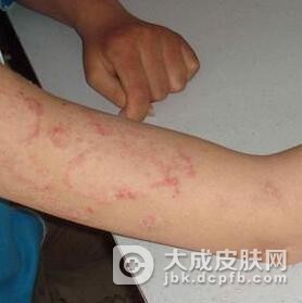 副银屑病用什么药