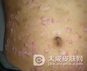 副银屑病患者怎么办