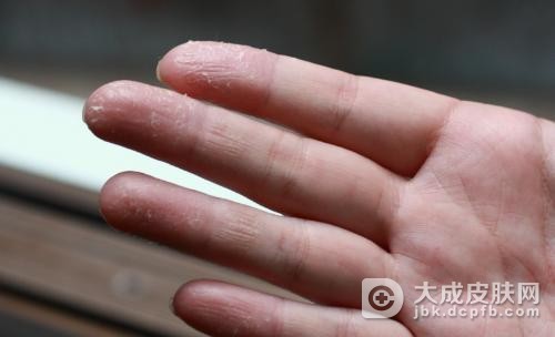 什么是手足皲裂