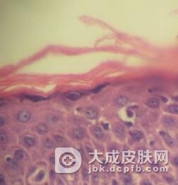 蕈样肉芽肿的发病原因