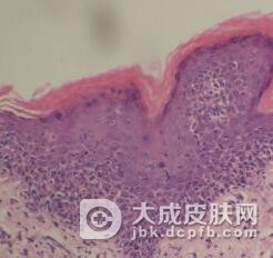 蕈样肉芽肿饮食的注意事项是什么