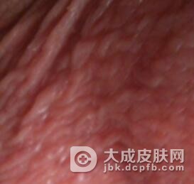 阴囊湿疹是怎么形成的