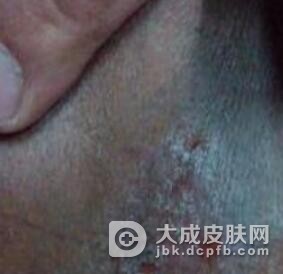 阴囊湿疹有哪些注意事项