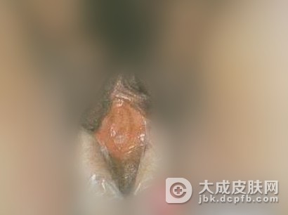 女性容易患上哪些种类的性病呢 性病症状 大成皮肤网