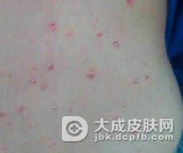 青少年患银屑病的原因是什么