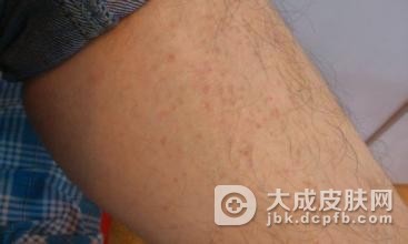 疥疮饮食禁忌有哪些