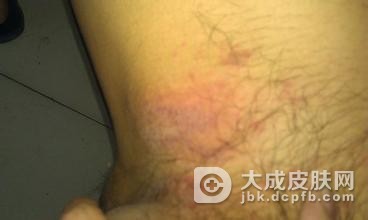 预防疥疮的正确方法都有什么呢