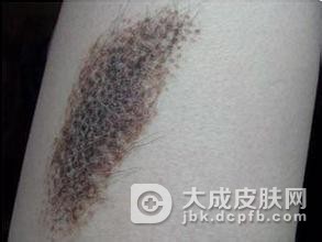 青胎记的日常护理有哪些注意事项呢