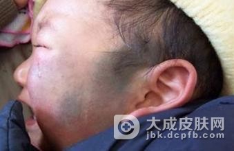 宝宝红色胎记怎么办