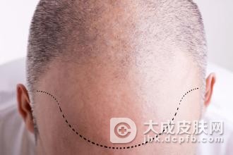 避孕药诱发女性脱发的原因
