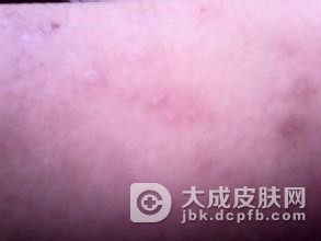 单纯性疱疹的病因有哪些呢
