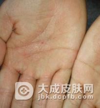 手部湿疹是怎么形成的