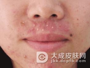 聚合性痤疮的原因有哪些