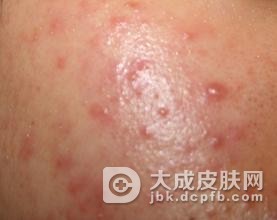 吃海带容易产生聚合性痤疮