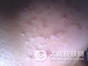 痤疮的预防及调理