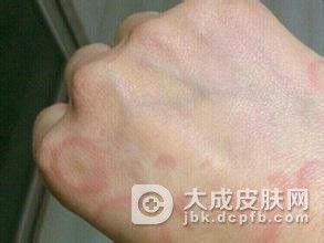 遗传过敏性皮炎的原因和常见症状