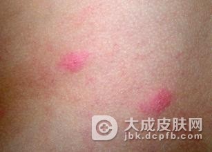 遗传出现过敏性皮炎该怎么护理