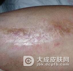 诊断治疗局限性硬皮病
