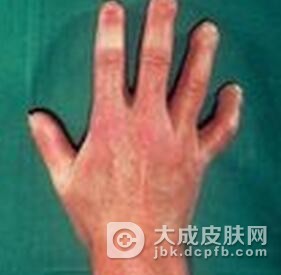 局限性硬皮病有哪些特点