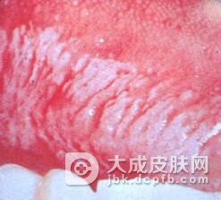 口腔黏膜白斑的发病特点