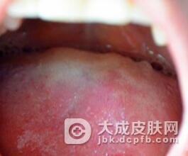 外阴黏膜白斑有什么鉴别诊断