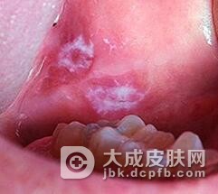 黏膜白斑有哪些处理方法