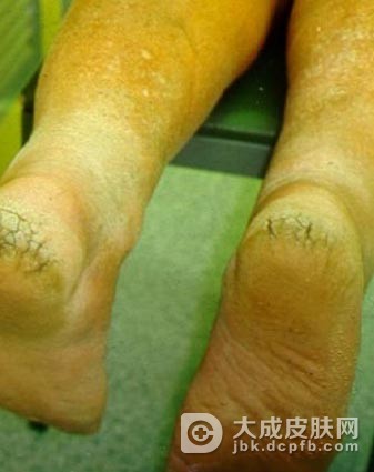 手足皲裂患者应该注意哪些日常的护理