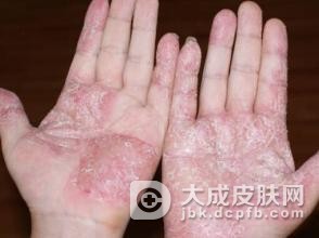 手足癣的传播途径
