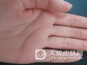 手足癣表现出来的症状有哪些