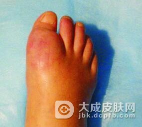 痛风的鉴别疾病是什么