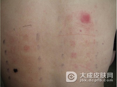 腿部异位性皮炎的原因是什么
