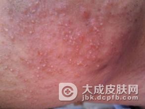蔬菜也会引起日光性皮炎吗