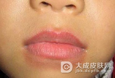如何有效预防疱疹样皮炎