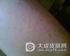 压迫性荨麻疹需要注意些什么