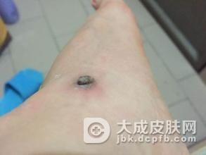 寻常疣的治疗偏方有哪些