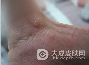生活中寻常疣要注意什么