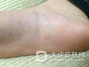 寻常疣患者应该食用哪些食物