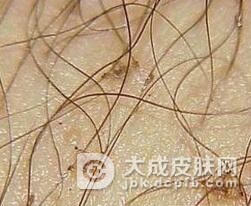 阴虱病的常见症状