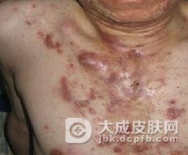 糠秕孢子菌毛囊炎的主要表现都有什么