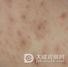 糠秕孢子菌性毛囊炎怎么检查